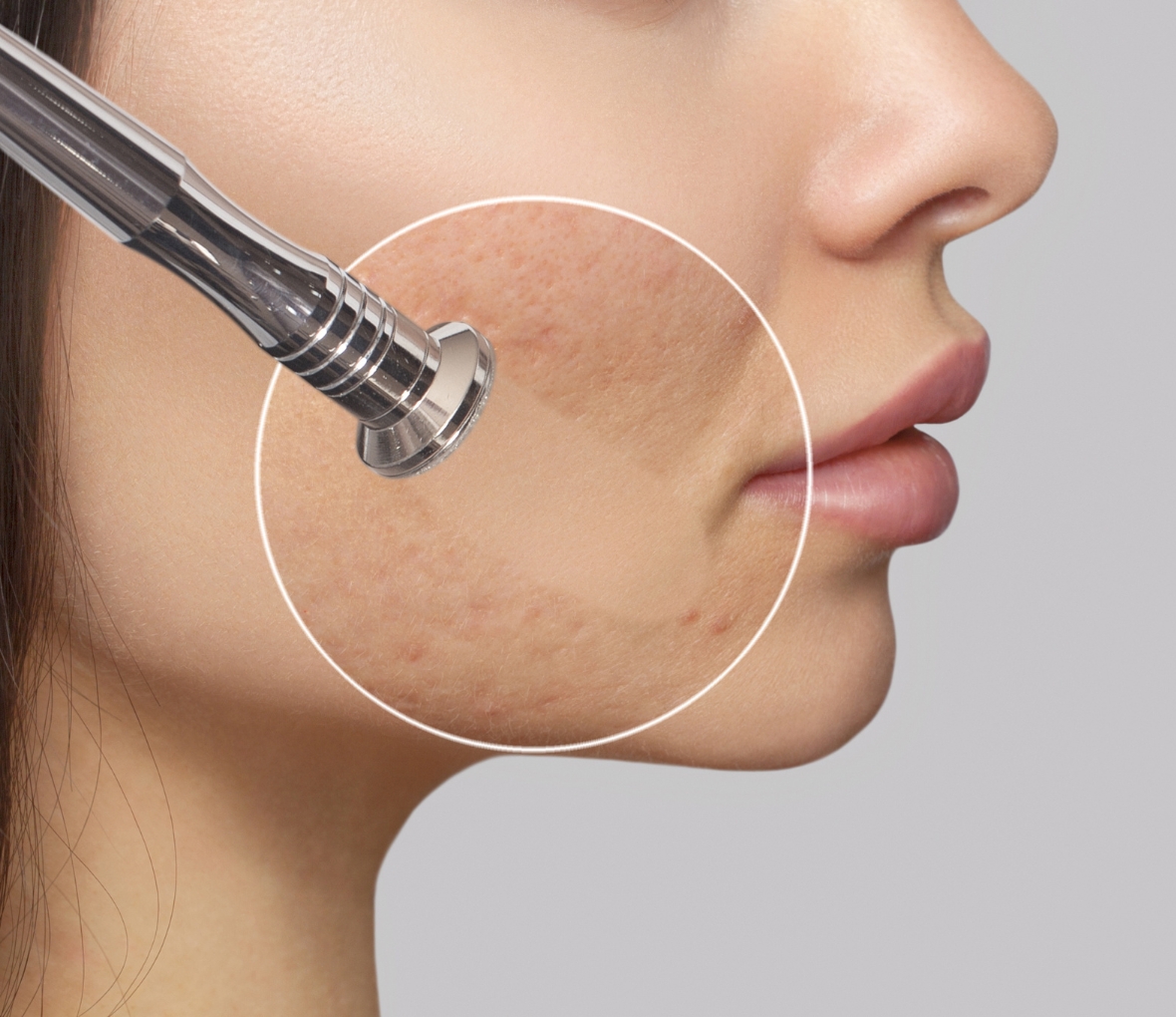 Microdermabrasion