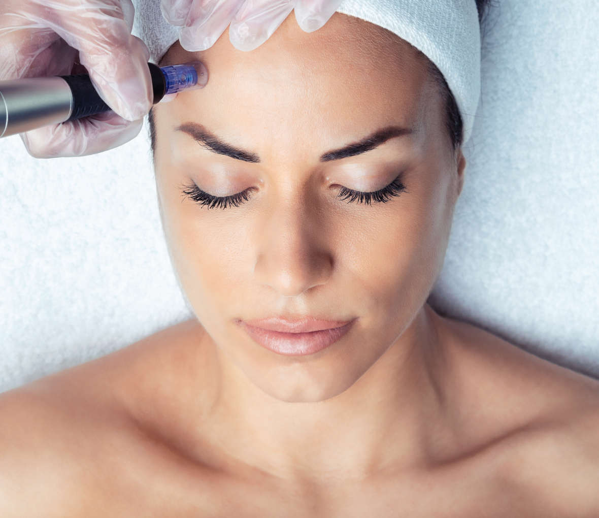 Skin needling