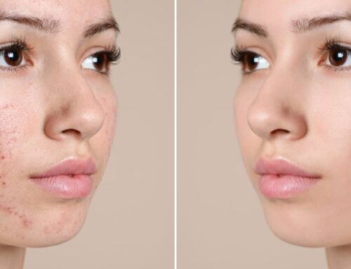 Skin Treatments Adelaide: Find the Best Options