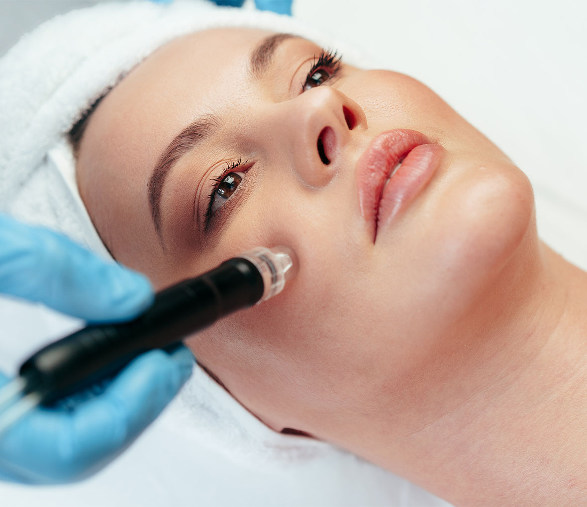 Microdermabrasion Adelaide
