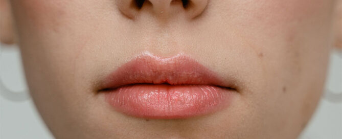 lip hydration treatment